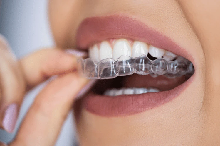 Orthodontic Aftercare and Maintenance Strategies